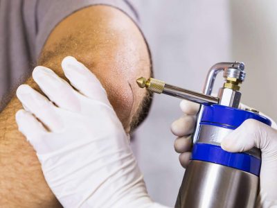 ASLA-cryotherapy